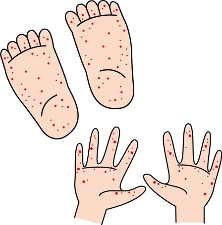Hand,Foot,and-Mouth-disease (HFMD).jpg